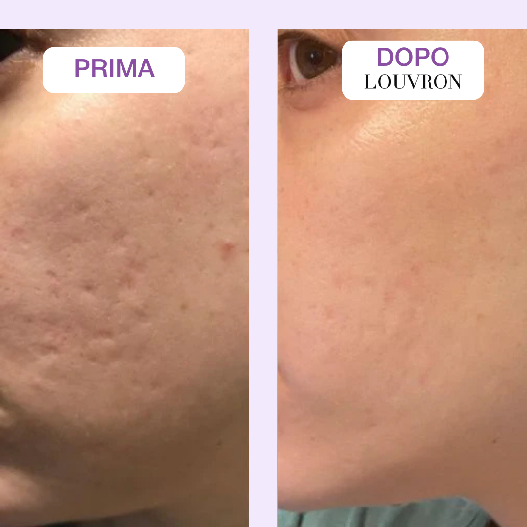 Nastro Bio-Silicone Collagene Anti-Età e Cicatrici