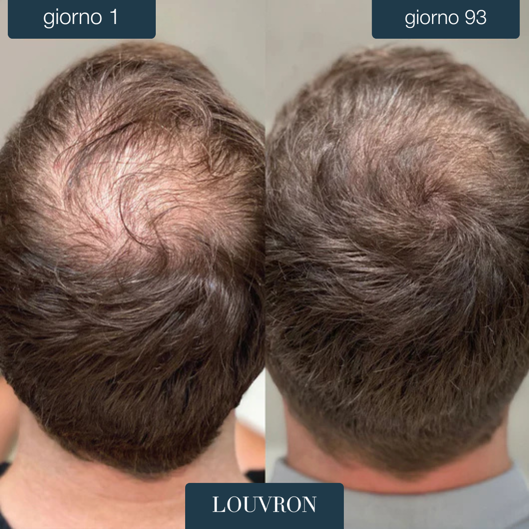 Louvron RootBoost™